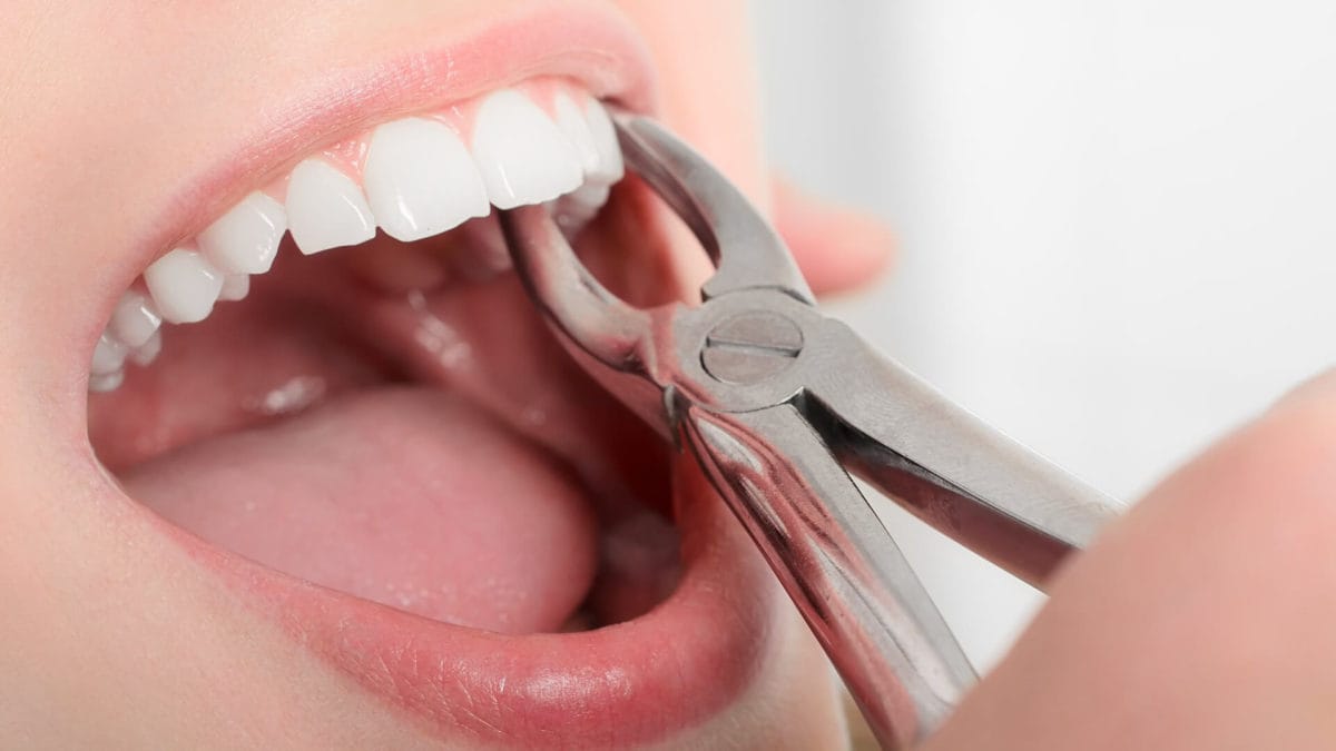 Tooth Extraction Vadodara